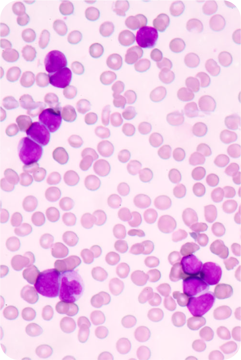 acute myloid leukemia (AML) cells