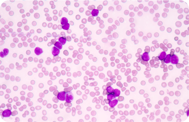 Blood smear showing acute myeloblastic leukemia (AML)